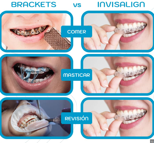 brackets vs invisalign