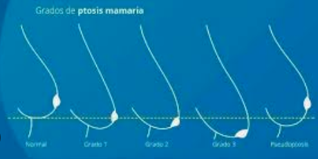 grados ptosis mastopexia