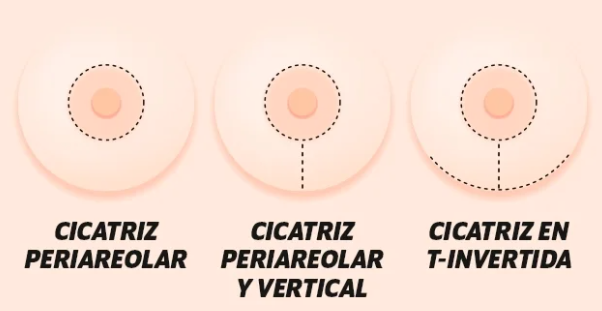 cicatrización de mastopexia