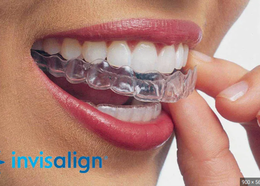 tratamiento oinvisalign